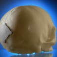 Ein Loch im Kopf wird im medizinischen Ernstfall häufig mit einem Implantat versorgt. Während Ersatz aus Titan lediglich Lücken schließt, fördert ein neuartiges resorbierbares Implantat die Regeneration des Körpers: Es […]