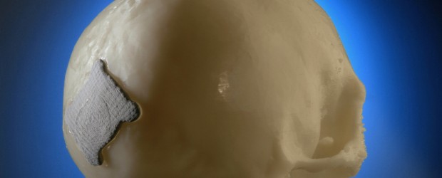 Ein Loch im Kopf wird im medizinischen Ernstfall häufig mit einem Implantat versorgt. Während Ersatz aus Titan lediglich Lücken schließt, fördert ein neuartiges resorbierbares Implantat die Regeneration des Körpers: Es […]